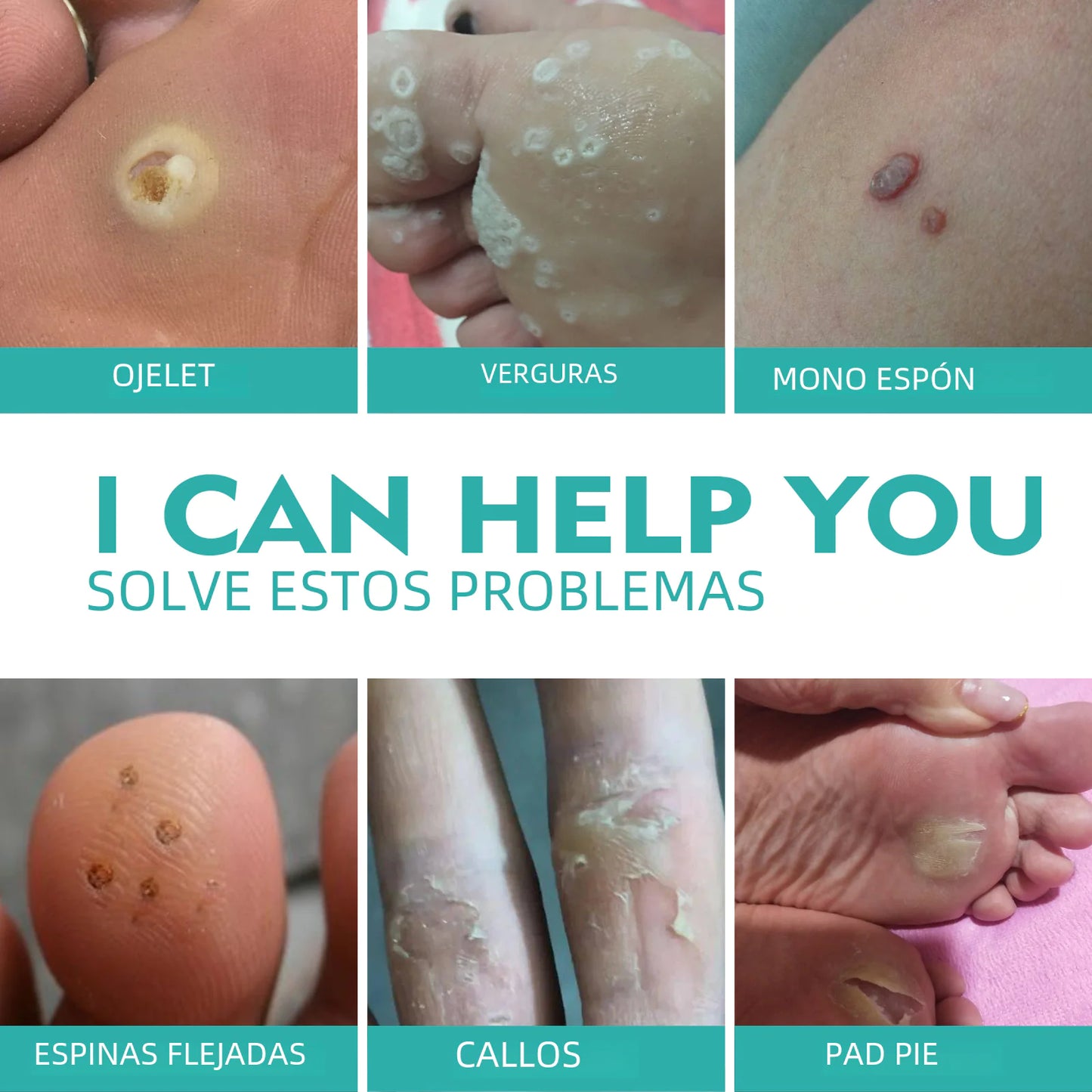 West&Month Wart Removal Pen for Smooth Skin Repair