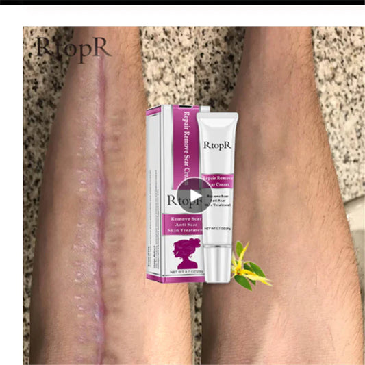 Acne Scar Removal Cream for Skin Repair and Healing